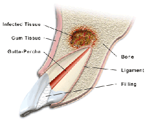 apicoectomy